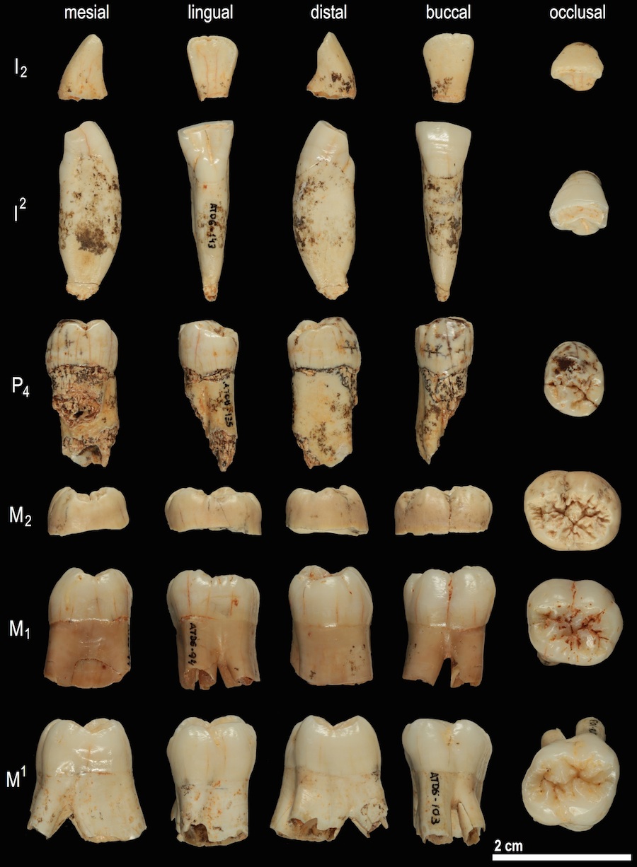 Para el trabajo, se estudió un diente de Homo antecessor utilizando análisis de proteínas antiguas. Crédito: Prof. José María Bermúdez de Castro.