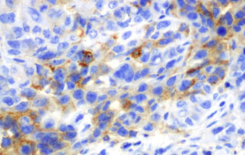 Células tumorales ricas en el receptor CXCR4 teñidas en azul. Imagen: Ramon Eritja (IQAC)